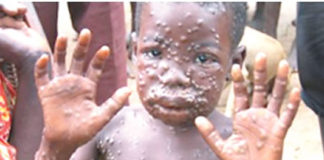 15 दिन में 15 देशों तक पहुंचा मंकीपॉक्स, भारत में जारी हुआ वायरसअलर्ट, जानें क्या है लक्षण