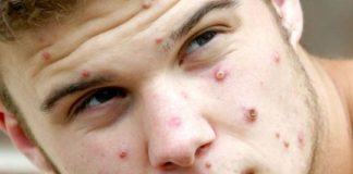 भारत में मंकीपॉक्स की दस्तक, उत्तरप्रदेश में मिला पहला केस, जानें क्या है इस वायरस के लक्षण