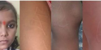 बच्ची के शरीर पर उभर रहे ‘राम और राधे’ नाम के शब्द, निशान देख डॉक्टर भी हुए हैरान