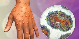 भारत में मिला Monkeypox का खतरनाक स्ट्रेन, WHO ने हेल्थ इमरजेंसी घोषित किया, जानें पूरा मामला?